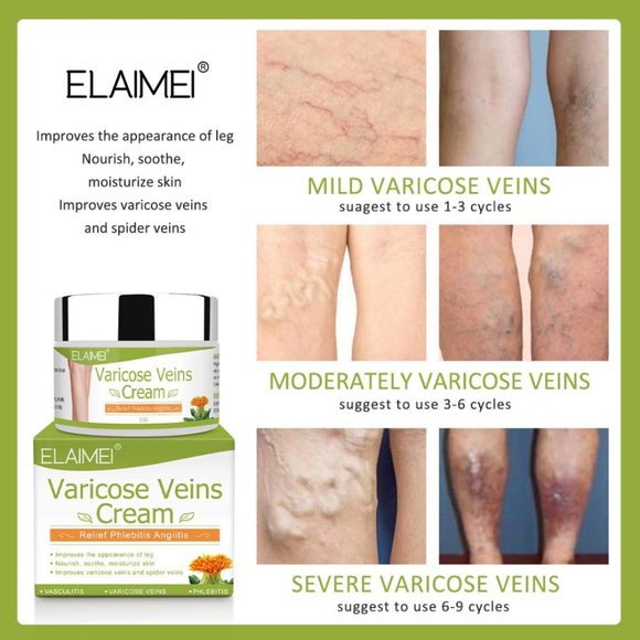 Varicose Veins Cream Relief Phlebitis Angiitis Inflammation Blood Vein - Picture 6 of 14